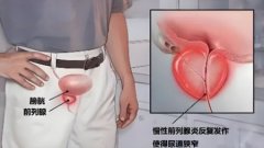 前列腺炎对性功能有影响吗