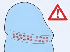 冠状沟长了一圈小米粒