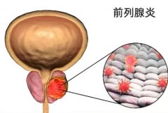 前列腺炎年轻人可以自愈吗