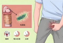 男性包皮溃烂是怎么回事
