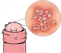 包皮上面长小疙瘩怎么回事