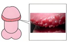 男性生殖长肉疙瘩的原因