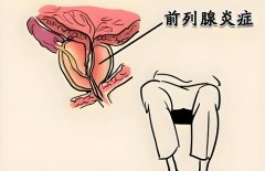 前列腺炎什么时候治疗好