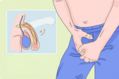 做包皮手术有什么好处